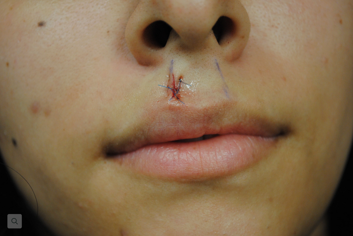 Excision - mole, face