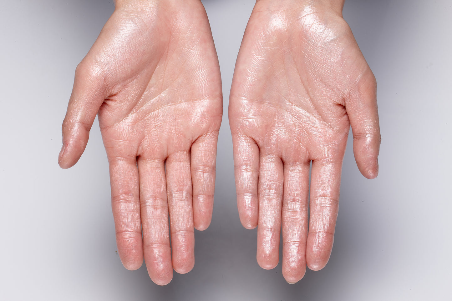 Botox - hyperhidrosis - hands