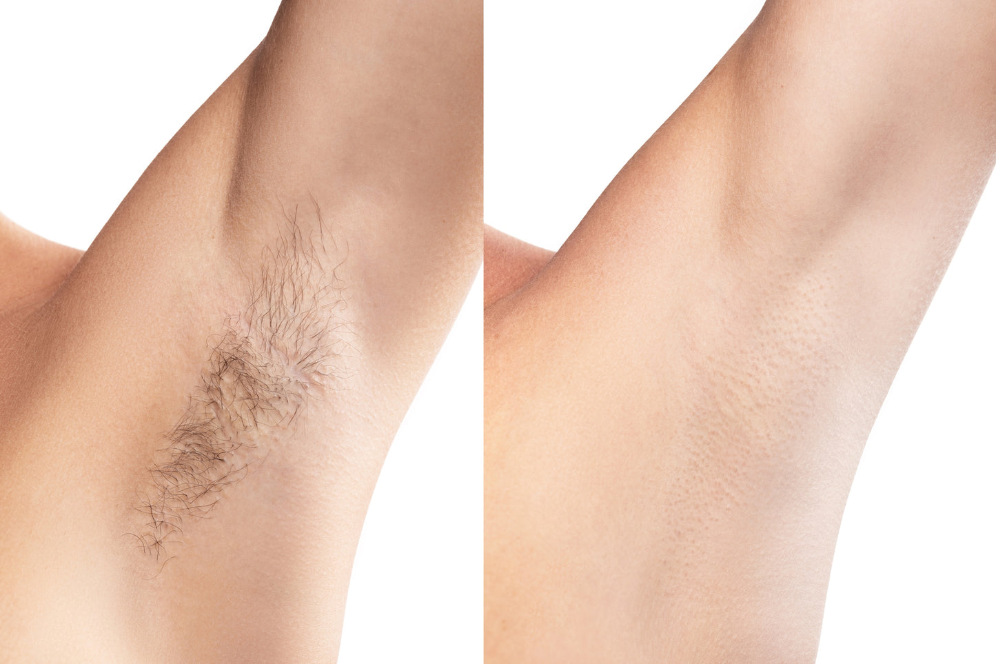 BBL Hair Removal - Underarms