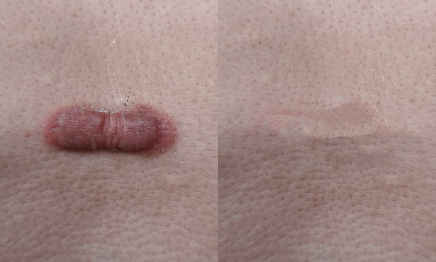 Injection of Lesions, same total price for up to 6 (Warts, Keloids, Scars, Keratoacanthomas)
