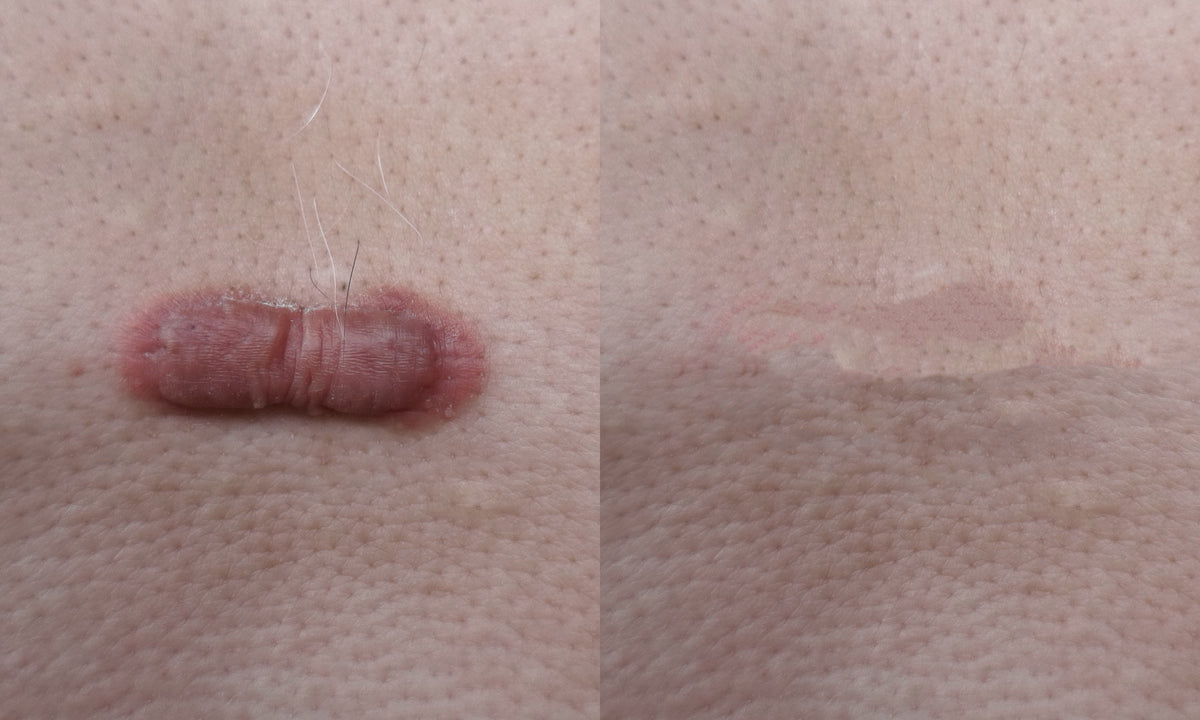 Multiple Injection Scar Injection for Keloid Scar or Cyst – Jennifer Baron, MD