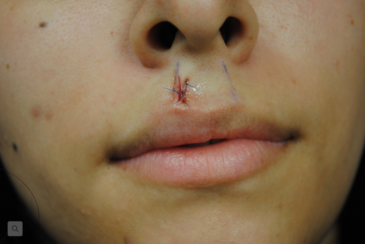 Excision - mole, face