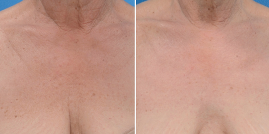 Broadband Light (BBL) - chest