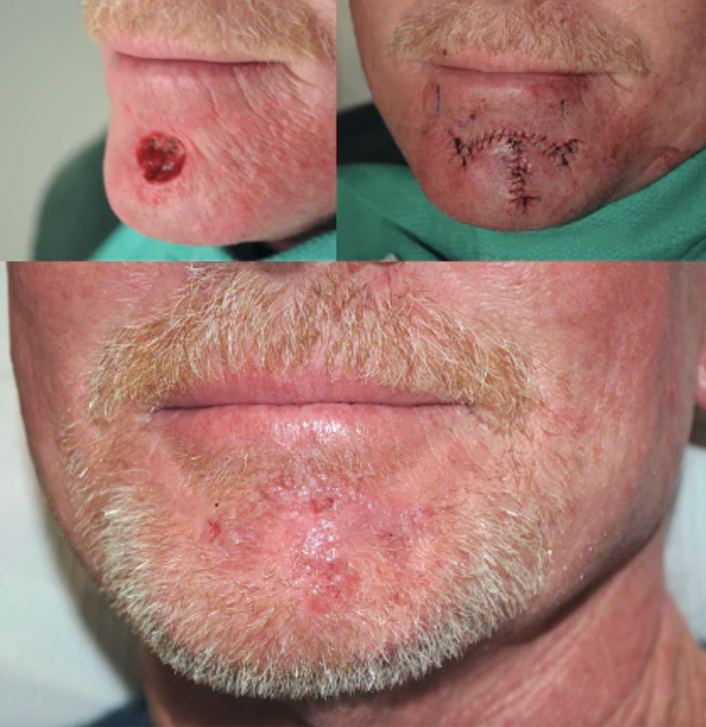 Micrographic Dermatologic Surgery (Mohs) for Skin Cancer