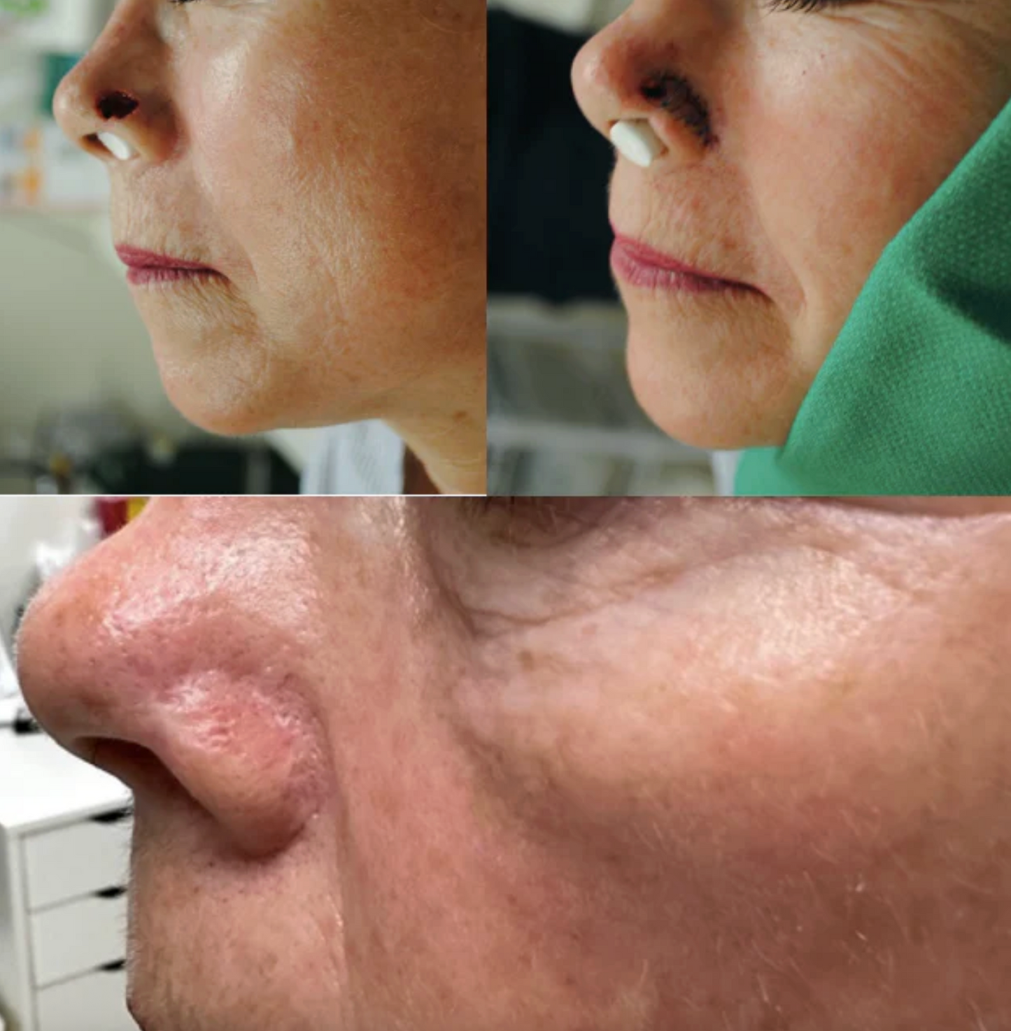 Micrographic Dermatologic Surgery (Mohs) for Skin Cancer