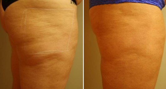 Halo + PRP crepey skin for thighs or arms