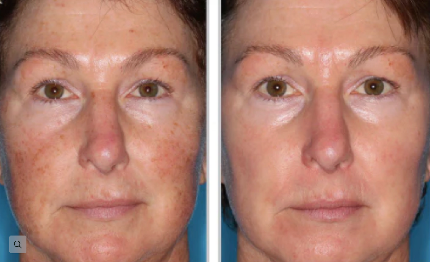 Halo Resurfacing Laser + PRP for Face + Neck