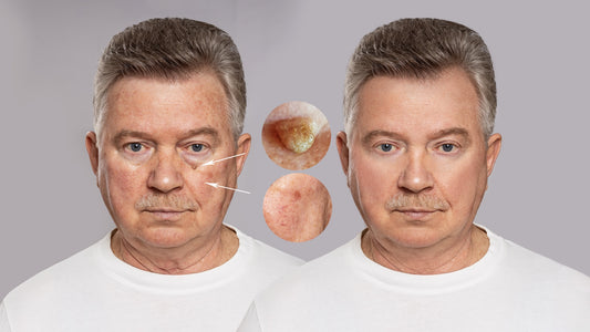 Destruction of Pre-Cancerous or Benign Lesions, 6 to 15 Lesions
