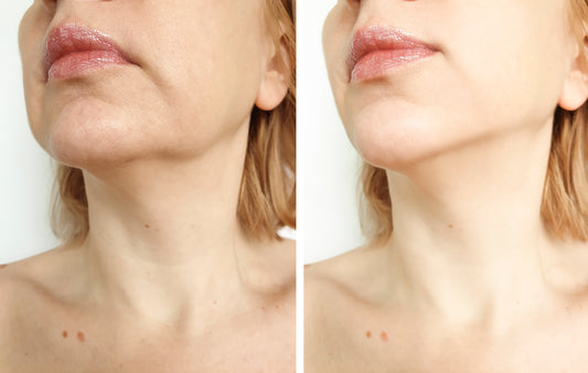 Facial Filler - Radiesse - Chin, Nose, Jawline Implant