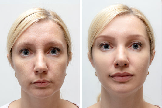 Facial Filler - Juvederm Ultra Plus - Face, Under Eyes, Lips, Temples