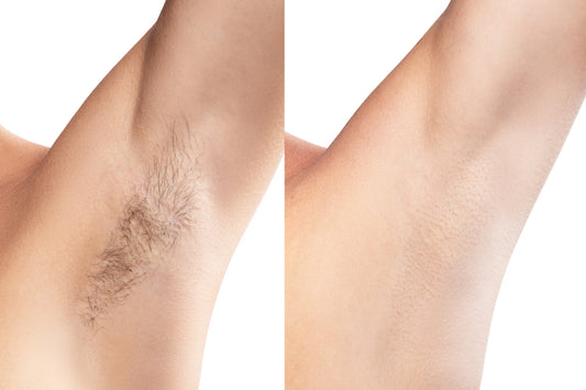 BBL Hair Removal - Underarms