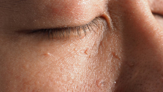 Fine-Needle Hyfrecation - Tags + Keratoses + Milia