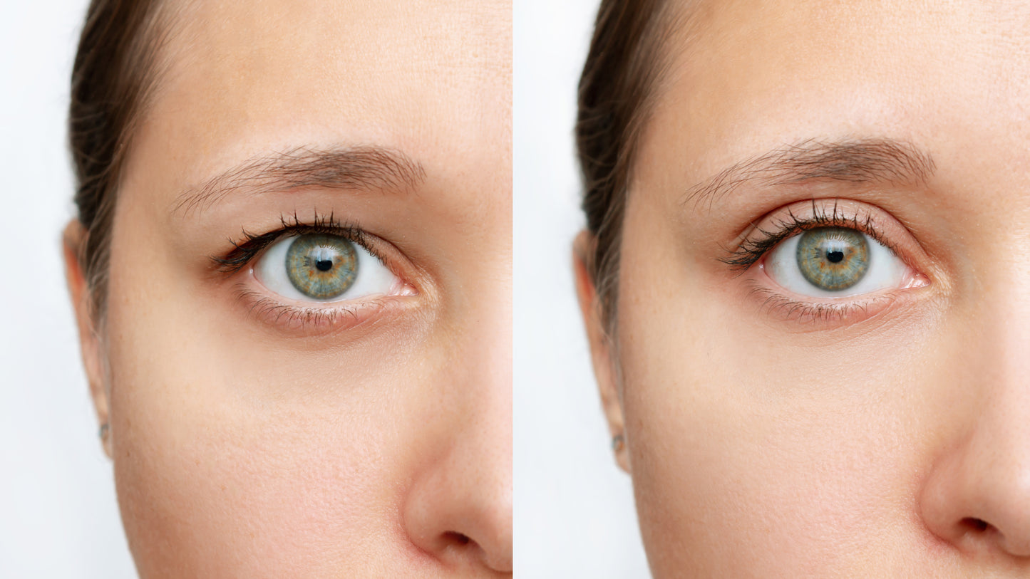 Blepharoplasty, In-Office Surgery for Upper Eyelid Heaviness