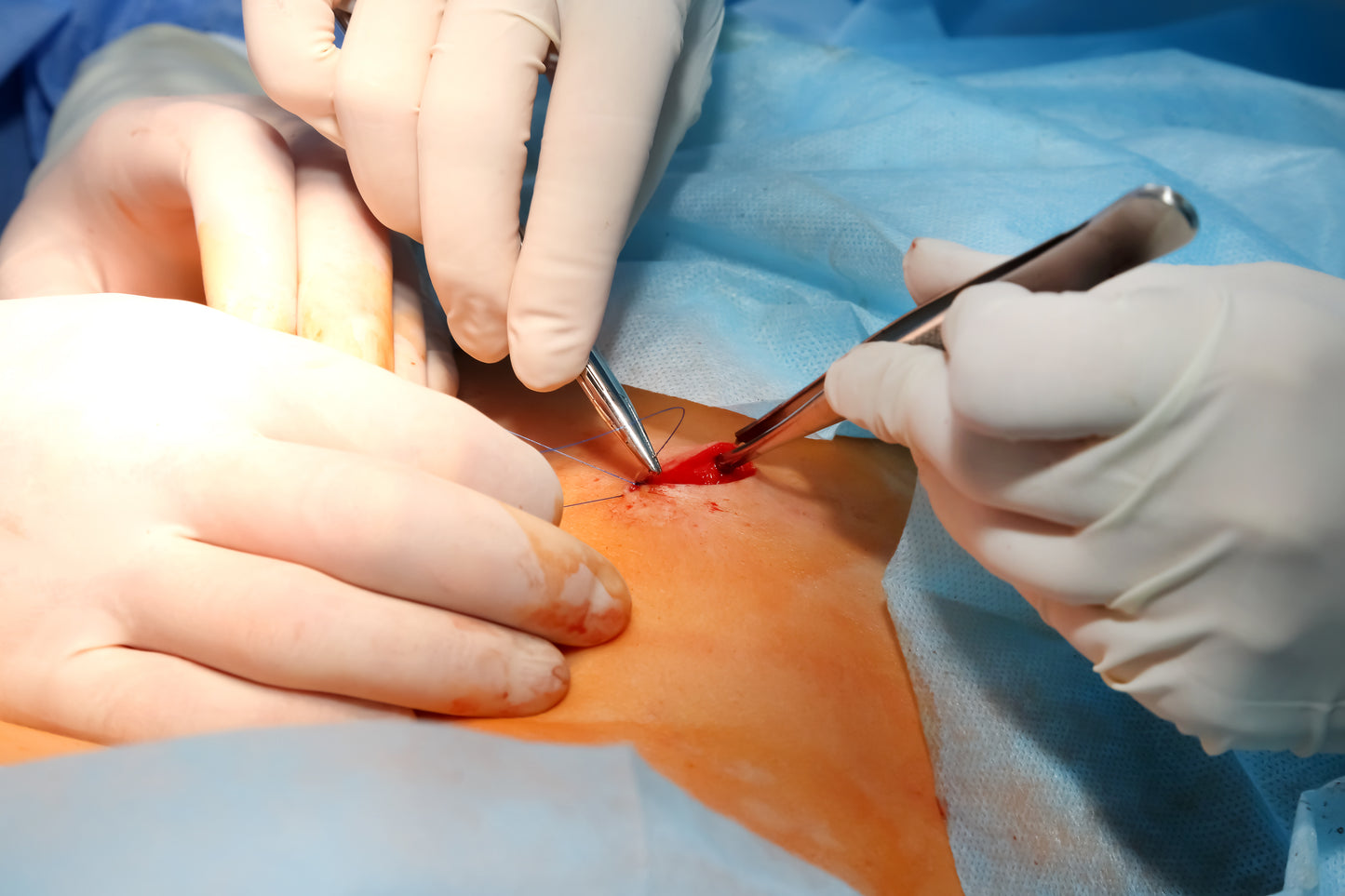 Excision - lipoma, neurofibroma, dermatofibroma, body