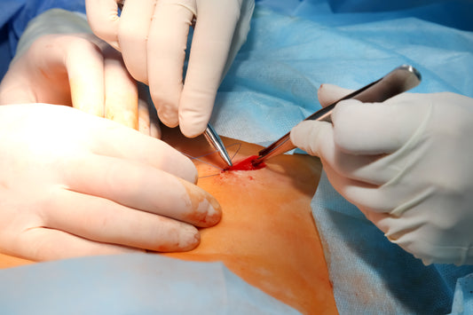 Excision - cyst, body or face