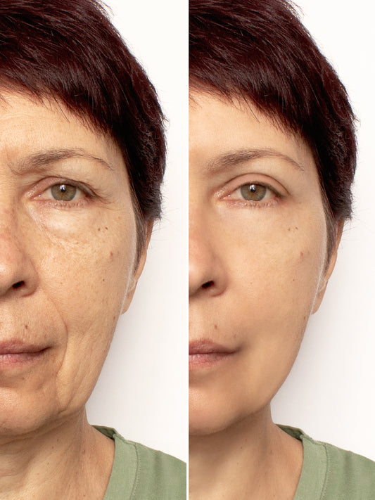 Botox - upper face "elevenses," "smile wrinkles"