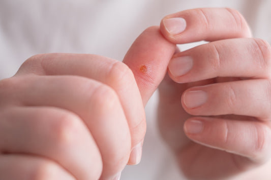 Wart Removal - 6 - 15 lesions