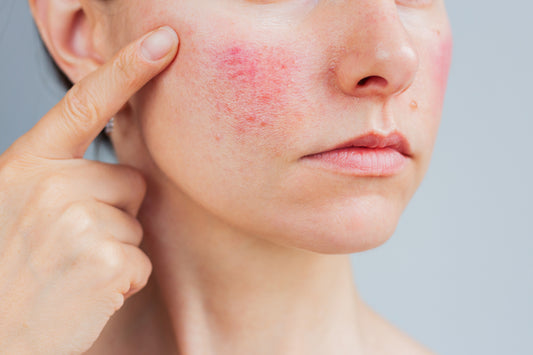 Broadband Light (BBL) - Nose + Cheeks
