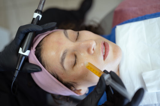 Microneedling + Platelet-Rich Plasma, face